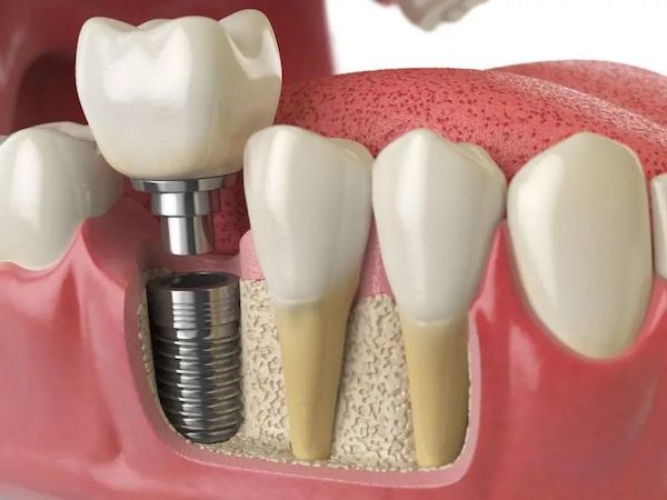 are-dental-implants-worth-it-in-santa-clarita