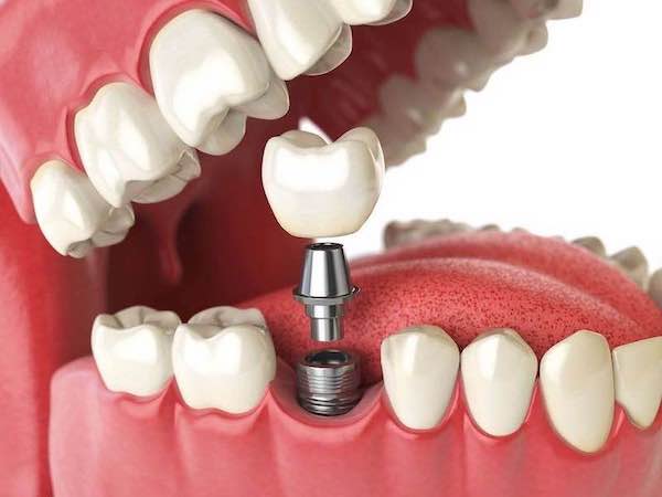 best-dental-implants-santa-clarita